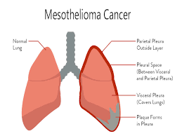 The mutations tell the cell to grow and multiply. Mesothelioma Symptoms Diagnosis And Treatment Charismatic Planet