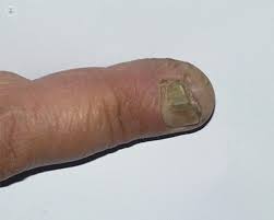 Onicomicosis Que Es Sintomas Y Tratamiento Top Doctors
