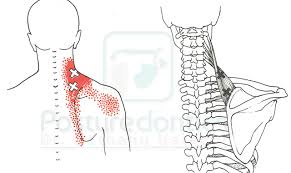 Trigger points (trps) or muscle knots are sore spots in soft tissue that cause deep aching. How To Treat Pain Caused By Trigger Points Dental Products Report