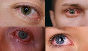 Image result for Eye Pain without Redness