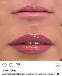 All Makeup In 2021 Lip Fillers Botox Lips Lip Fillers Juvederm
