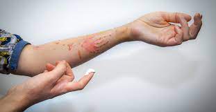 كيف تتعامل مع الحروق دليلك الشامل ويب طب