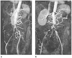 Mra Of The Abdominal Aorta And Lower Extremities Grist 2000 Journal Of Magnetic Resonance Imaging Wiley Online Library