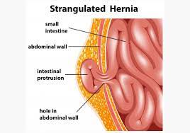 Une hernie inguinale doit être opérée dans les semaines qui suivent sa détection. Ce Este Si De Ce Apare Hernia Inghinala Hernia Inghinala Face Parte Din Categoria Herniilor Abdominale Si Afecteaza Cu Precadere Barbatii Aceasta Nu Se Vindeca De La Sine Si Daca Nu Este