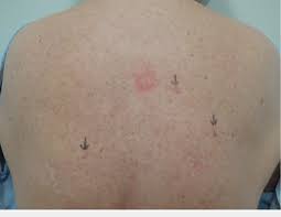People of any age can get skin cancer, and signs are more widespread than just a mole or suspicious spot in an obvious place. Clinical Presentation Of A Red Dot Basal Cell Carcinoma On The Left Mid Download Scientific Diagram