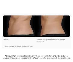 According to carmen kavali, md, an atlanta plastic surgeon via realself.com, she noted the pricing for coolsculpting by zeltiq is protected by the manufacturer, meaning the pricing will be nearly the same everywhere, but some practices may offer special events while other offices may hold a special promotion. Coolsculpting Prices In Canada Coolsculpting Toronto