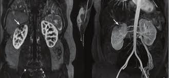 Image result for Renal Infarction