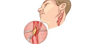 This article will focus on the cause of neck instability causing pressure on the nerves, arteries and veins that run through the cervical spine and into the. Carotid Stenosis Baylor Medicine