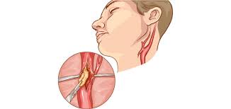 We did not find results for: Carotid Stenosis Baylor Medicine