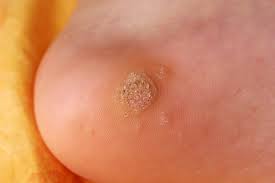 A plantar wart, or verruca, is a wart occurring on the bottom of the foot or toes. What Are Plantar Warts And How Do You Get Rid Of Them Health Com