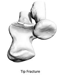 Image result for Coronoid Process Fracture