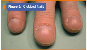 Image result for Clubbing nails feet
