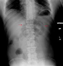 Image result for Adynamic Ileus