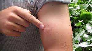 Bites And Stings Pictures Causes And Symptoms