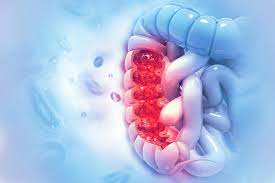 Stage 4 colon cancer is the most advanced stage of the disease and may also be referred to as metastatic colon cancer. Understanding Metastatic Colorectal Cancer Treatment Options In 2020 Parkway Cancer Centre Singapore