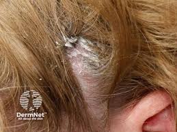 Image result for white scabs on the head in children