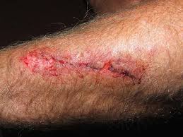 May 31, 2018 · a few minor signs to help you know if your cut is infected include you notice some swelling around your cut. Is My Wound Infected Pus And Other Signs To Watch For