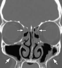 Maxillary Sinus Abnormal