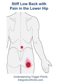 More than 26 million americans, between the ages of 20 and 64, experience back pain (1) and, very often, lower back and hip pain are related. Pin On Hip Trigger Point Pain