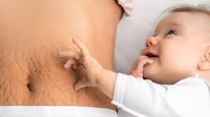 How Witch Hazel May Help Improve Your Stretch Marks