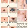 How do i know if i have testicular cancer? 1