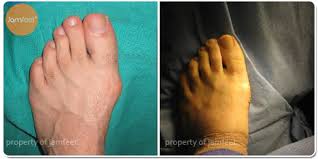 After eight to ten weeks they may start to do an elliptical machine or more weight bearing exercises. Before After Bunion Surgery Photo Gallery Los Angeles Foot Doctor Beverly Hills
