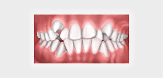 「" 	 crowding」的圖片搜尋結果