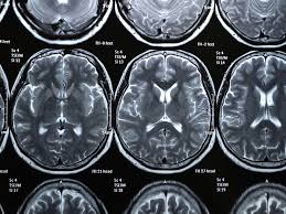 In actuality, grey matter or gray matter is the embodiment of all the neurons (or more precisely, neuronal cell bodies) and their synaptic interactions in the brain cortex. Covid 19 Survivors May Suffer From Loss Of Gray Matter Over Time Study