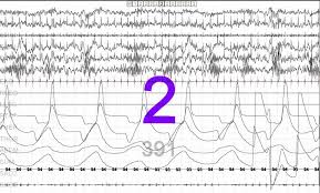 Can You Determine Which Medication A Patient Is Taking