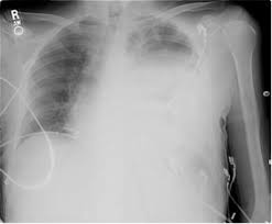 Treatment depends on the cause. Case 8 Answers Pleural Effusions Clinical Respiratory Diseases Critical Care Medicine Seattle Med 610 University Of Washington School Of Medicine