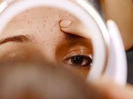 Jadi, bagaimana anda mencapai keseimbangan yang sempurna? Apa Yang Harus Dilakukan Jika Kamu Memiliki Kulit Kering Dan Berjerawat Facetofeet Com