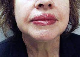 Allergic Reaction To Ingredient In Lipstick