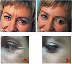 Reconstituted xeomin may be stored in a refrigerator at 2° to 8°c (36° to 46°f) for up to 24 hours until time of use *when using 8 ml of diluent for a 100 unit or 200 unit vial of xeomin, complete the following steps: Botulinum Toxin The Dermatology Clinic