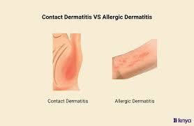 Image result for Contact Dermatitis