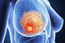 Maybe you would like to learn more about one of these? Breast Cancer Surgery Dr Senarath Edirimanne