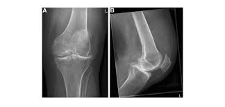This ability varies with different substances; Predictors Of Osteoarthritis After Acl Repair Orthopedics This Week