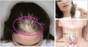 The Most Important Reasons Women Lose Hair Lost Hair Thick Hair Remedies Hair Loss Women