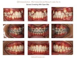 「" 	 crowding」的圖片搜尋結果