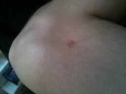 Image result for große winkelspinne biss haut reaktion