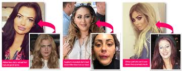 Her birth place is in newcastle upon she has also had several other surgeries including an eyebrow lift, nose job, lip fillers, dermal cheek fillers, dental veneers, as well as botox surgery. The Shocking Truth Behind The Filler Fad Save Face