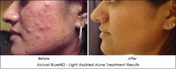 Medical Lasers Now Treat Acne Patients Ahb