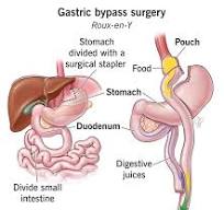 Gastric Bypass (Roux-en-Y) Surgery: Requirements & Recovery