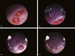 Image result for Bladder Irrigation