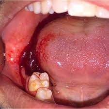 Severe Bleeding After Extraction Of The Second Mandibular Molar In A Download Scientific Diagram