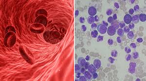 Un quinto dei pazienti leucemici non ha ancora ricevuto la diagnosi corretta. Leucemia Ecco Quali Sono I 9 Sintomi Che Dovrebbero Metterci In Allarme