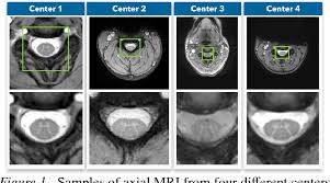Pdf Unsupervised Domain Adaptation For Medical Imaging Segmentation With Self Ensembling Semantic Scholar