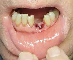 Pin On Healthy Teeth And Tips