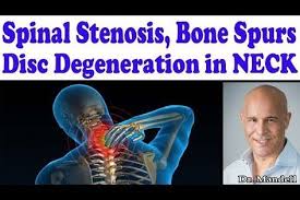 Best Strategies For Cervical Neck Spinal Stenosis Disc Degeneration Bone Spurs