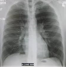 Image result for Chest XRay Interpretation