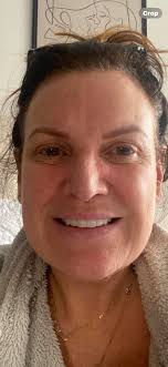 Any recommendations for South West England for upper Bleph and approximate  cost if possible, thanks.